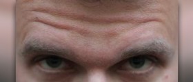 Wrinkles between eyebrows