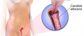 Be well unruffled to conquer chronic yeast infection