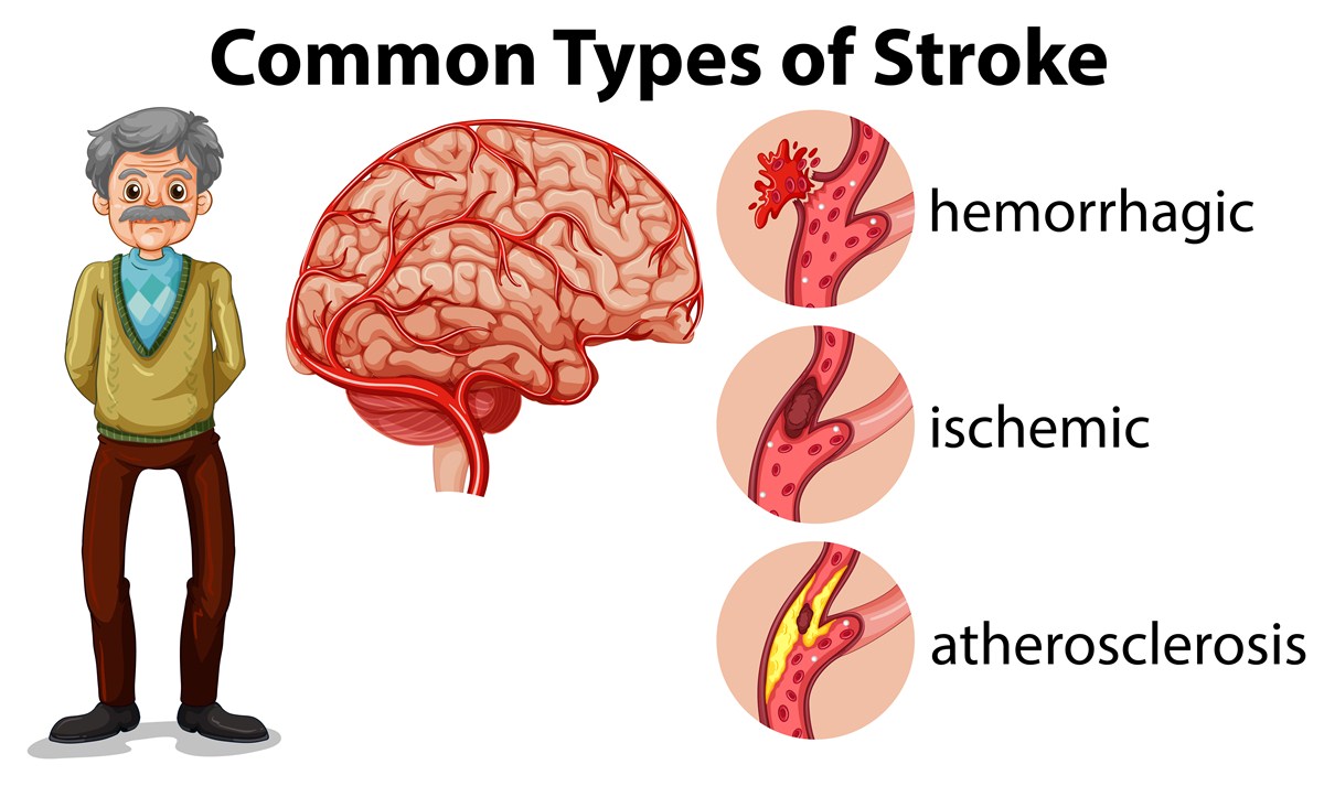 5-things-you-should-know-after-you-have-had-a-stroke-or-a-loved-one