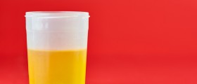 6 Reasons You Have High Uric Acid Levels