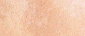 Acanthosis Nigricans - Dark Skin Between Legs And On Skin Folds