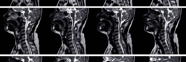 Branchial Cleft Cyst and other anomalies: Causes, Types, Symptoms, Treatment and Surgery