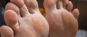 Bunions: What Is A Bunionectomy?