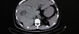 Causes Of Abdominal Mass