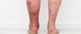 Causes of Lymphedema