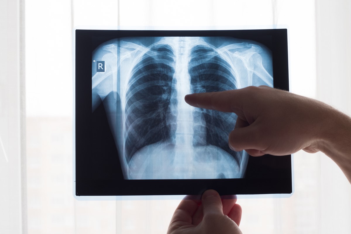 Chest X-Ray – Procedure And Basic Understanding Of Interpretation