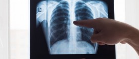 Chest X-Ray – Procedure And Basic Understanding Of Interpretation