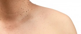Common Pimple-Like Growths (And What To Do About Them)