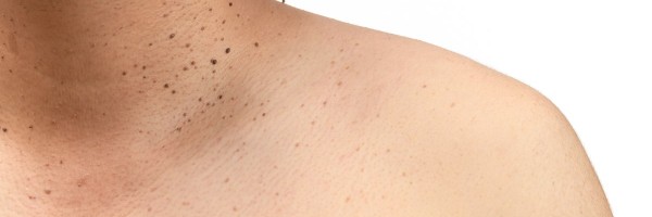 Common Pimple-Like Growths (And What To Do About Them)