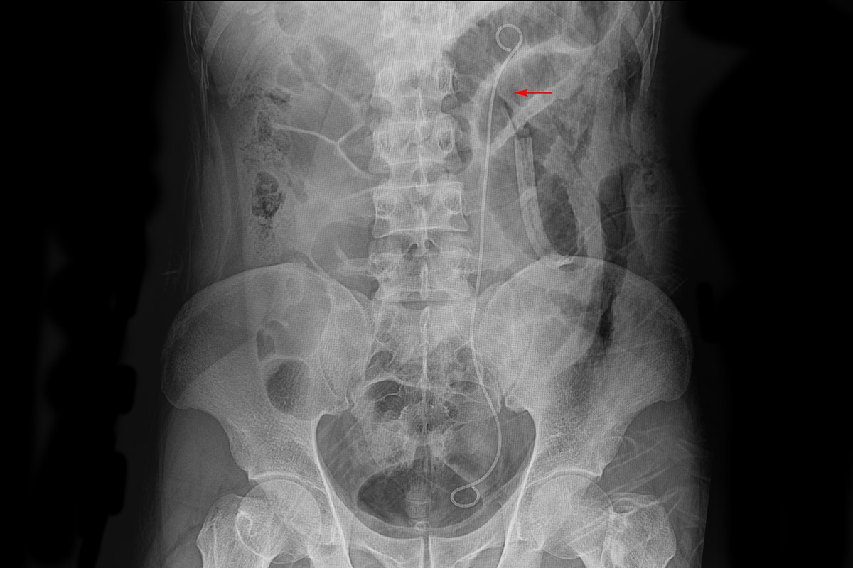 Complications After Ureteral Stent Placement Urinary