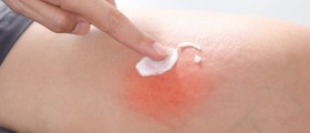 Contact Dermatitis - When Contact With Certain Products Causes An Allergic Reaction