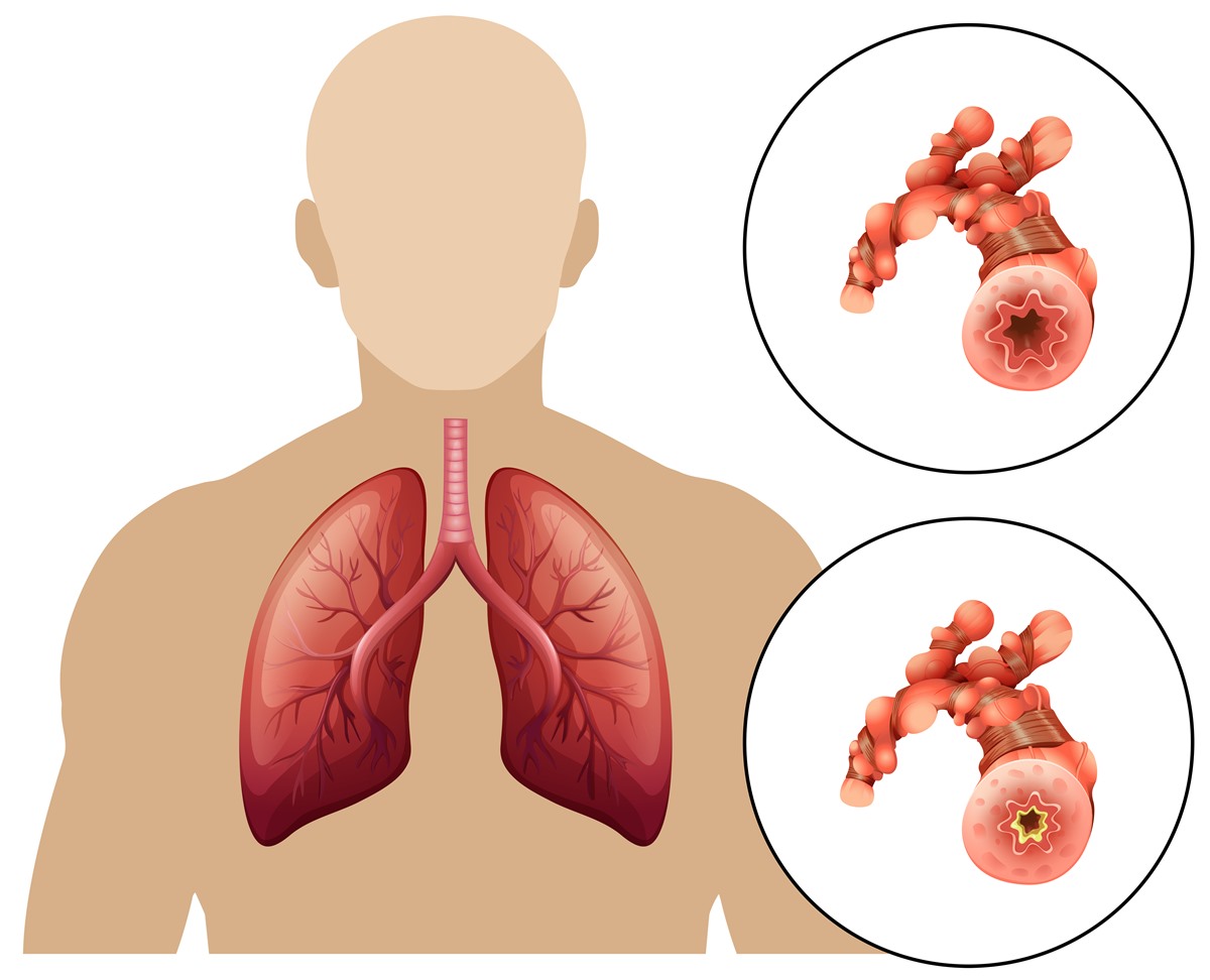 copd-and-back-pain-respiratory-tract-disorders-and-diseases-medical