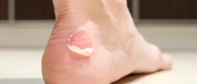Corns And Calluses: Definition, Symptoms, And Treatment