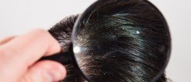 Could Eating Dandruff Flakes be Dangerous?