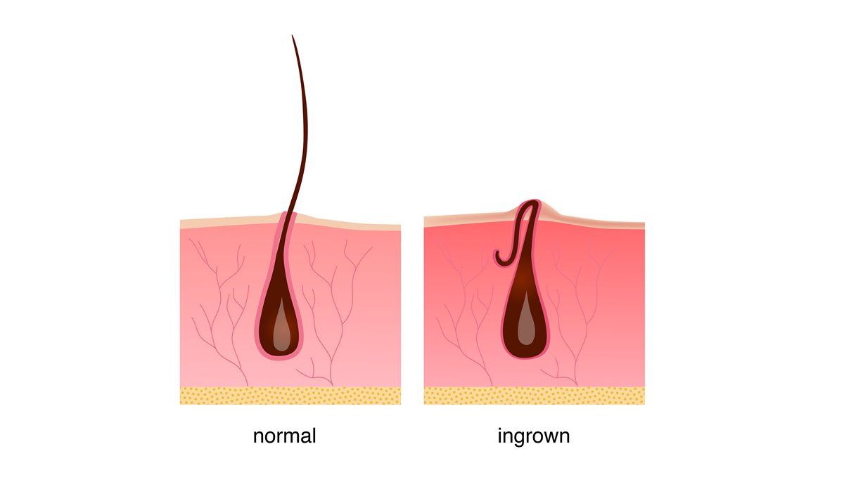 dark marks and scars from ingrown hair and irritation in pubic region