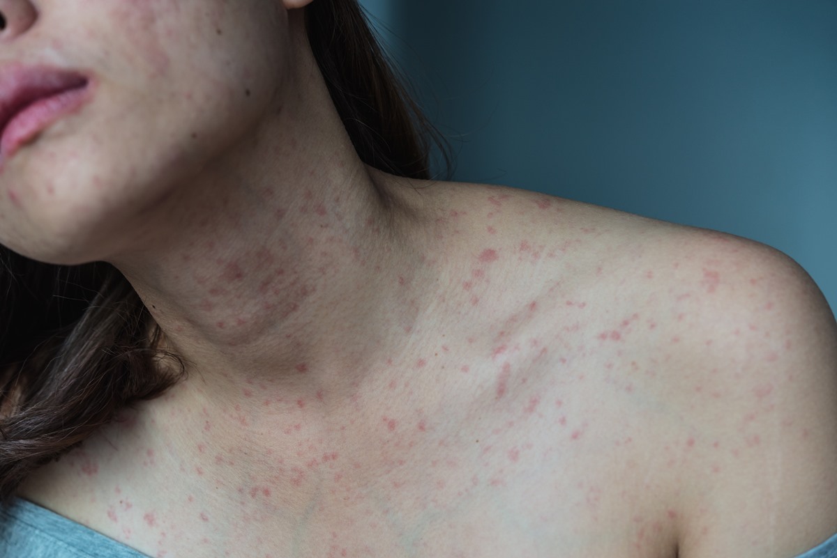 Dermatitis Under the Breast  Women's Health medical answers