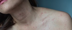 Dermatitis Under the Breast