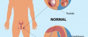 Do You Have A Hydrocele And Are You A Candidate For Hydrocele Surgery?