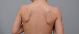 Erythema Nodosum, Also Known As Panniculitis, And What to Do About It