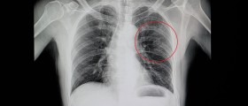 Fractured Rib: Causes, Symptoms And Treatment