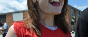 Getting Rid Of Hickeys