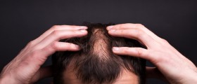 Hair Loss Following Accutane Treatment
