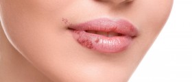 Herpes Simplex Infection: A Brief Overview