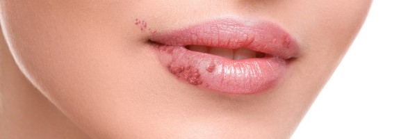Herpes Simplex Infection: A Brief Overview
