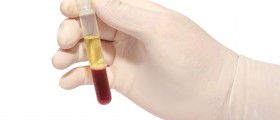 High White Blood Cell Count