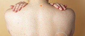 Hives And Tooth Abscess
