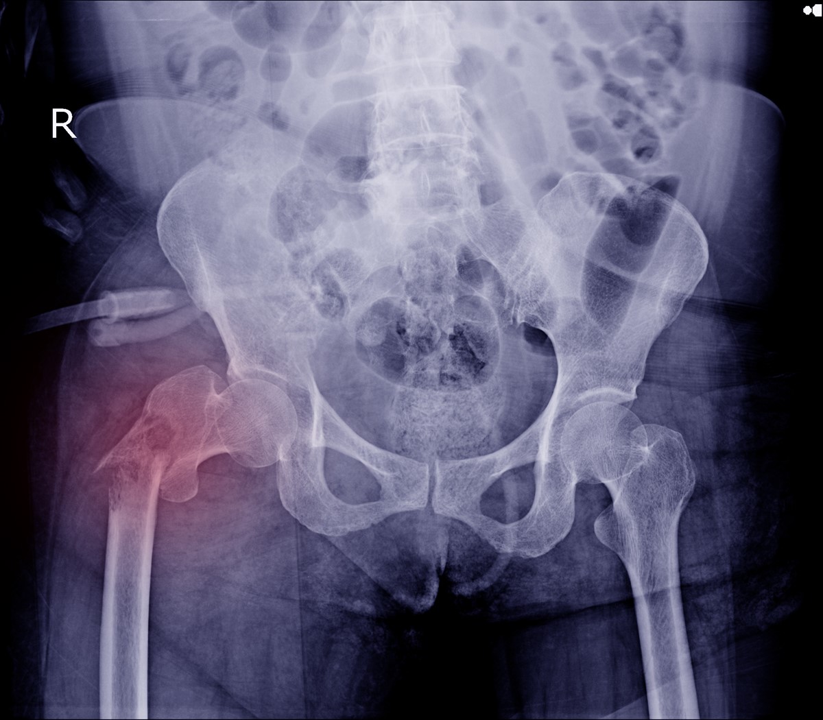 How Long Does It Take To Recover From A Broken Femur Musculoskeletal 