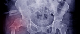 How Long Does It Take To Recover From A Broken Femur?