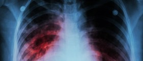 How Serious Is Interstitial Lung Disease?
