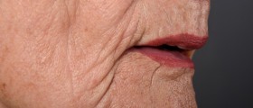 How To Prevent Or Reverse Sunken Cheeks Due To Weight Loss Or Aging