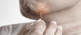 Ingrown Hair: Causes And Treatment