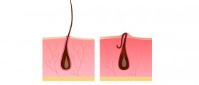 Ingrown Hair On The Stomach: What Now?