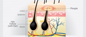 Ingrown Hairs And How They Present