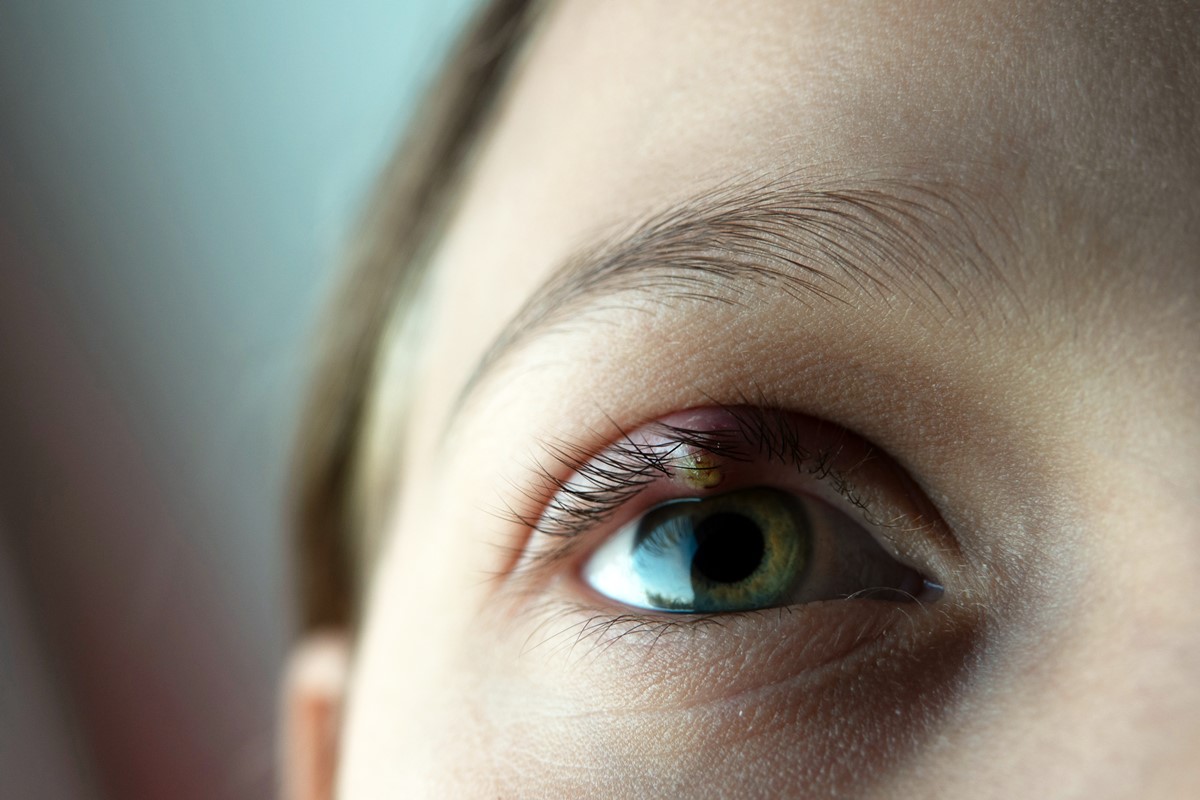 Internal and External Hordeolum (Stye): Symptoms, Diagnosis, and