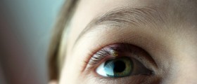 Internal and External Hordeolum (Stye): Symptoms, Diagnosis, and Treatment Options