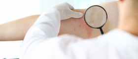 Intertrigo: What Can You Do About The Skin Rash That Affects Skin Folds?