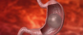 Intra-Gastric Balloon for Weight Loss