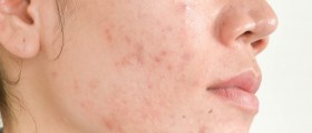 Is Semen Good For Treating Acne?