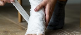 Jones Fracture