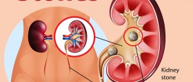 Kidney Stones: What Do You Need To Know?