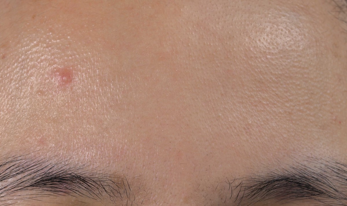 Lumps Bump And Cysts On The Eyebrow What Are They And How To Treat