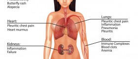Lupus: Everything You Need To Know