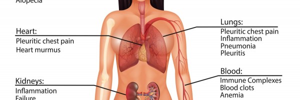 Lupus: Everything You Need To Know