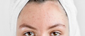Major Pimple Swelling: Why Does Acne Get Infected?