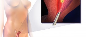 NovaSure Endometrial Ablation