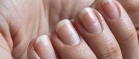Onycholysis - A Condition Where Nails Separate From The Nail Bed Spontaneously
